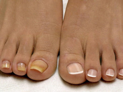 Актуальность грибковых заболеваний кожи и ногтей