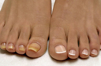 Актуальность грибковых заболеваний кожи и ногтей